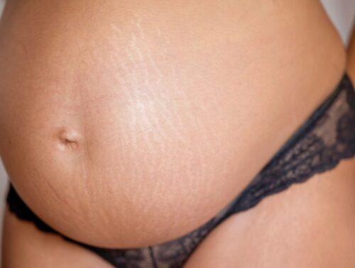 เจลทาท้องแตกลายคนท้อง